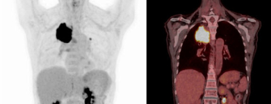 FDG PET/CT eines bifokalen Bronchuskarzinoms